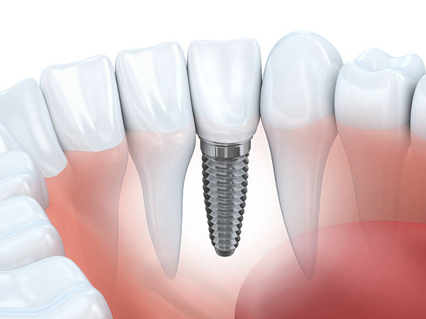 dental implants nusmile dental best dentists philadelphia